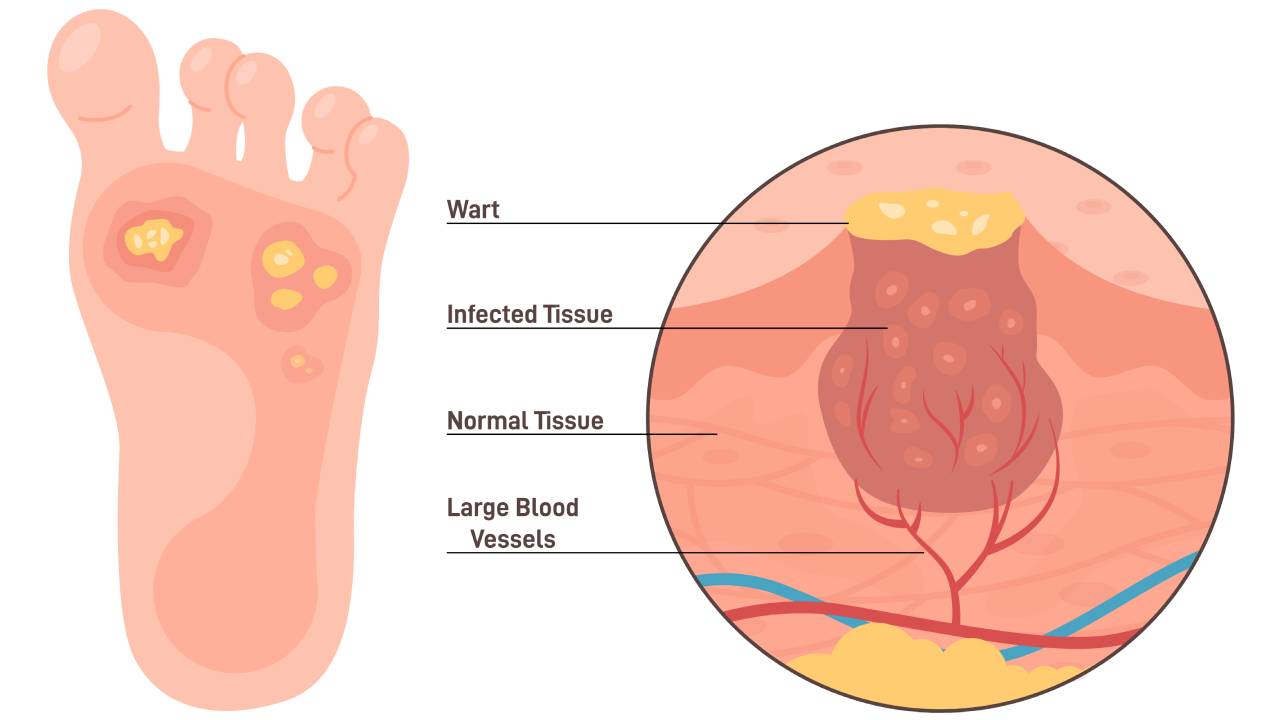 Wart on Foot